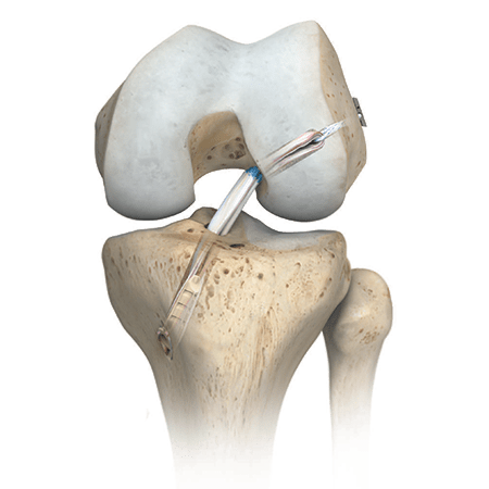 knee-arthroscopy-450×450-compress
