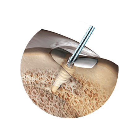 shoulder-arthroplasty-450×450-3-compressed